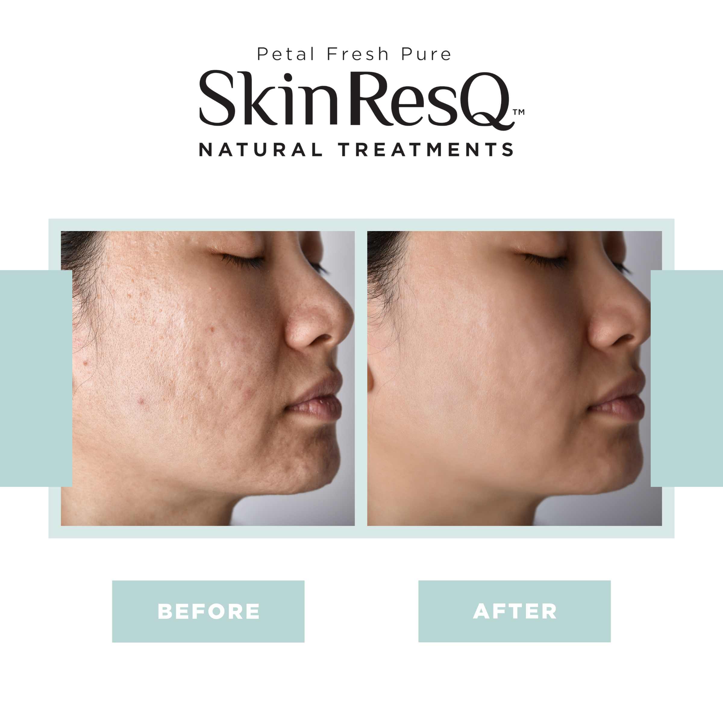 Skin ResQ Invisible Daytime Pimple Patches – Jumbo Pack (108 Count)