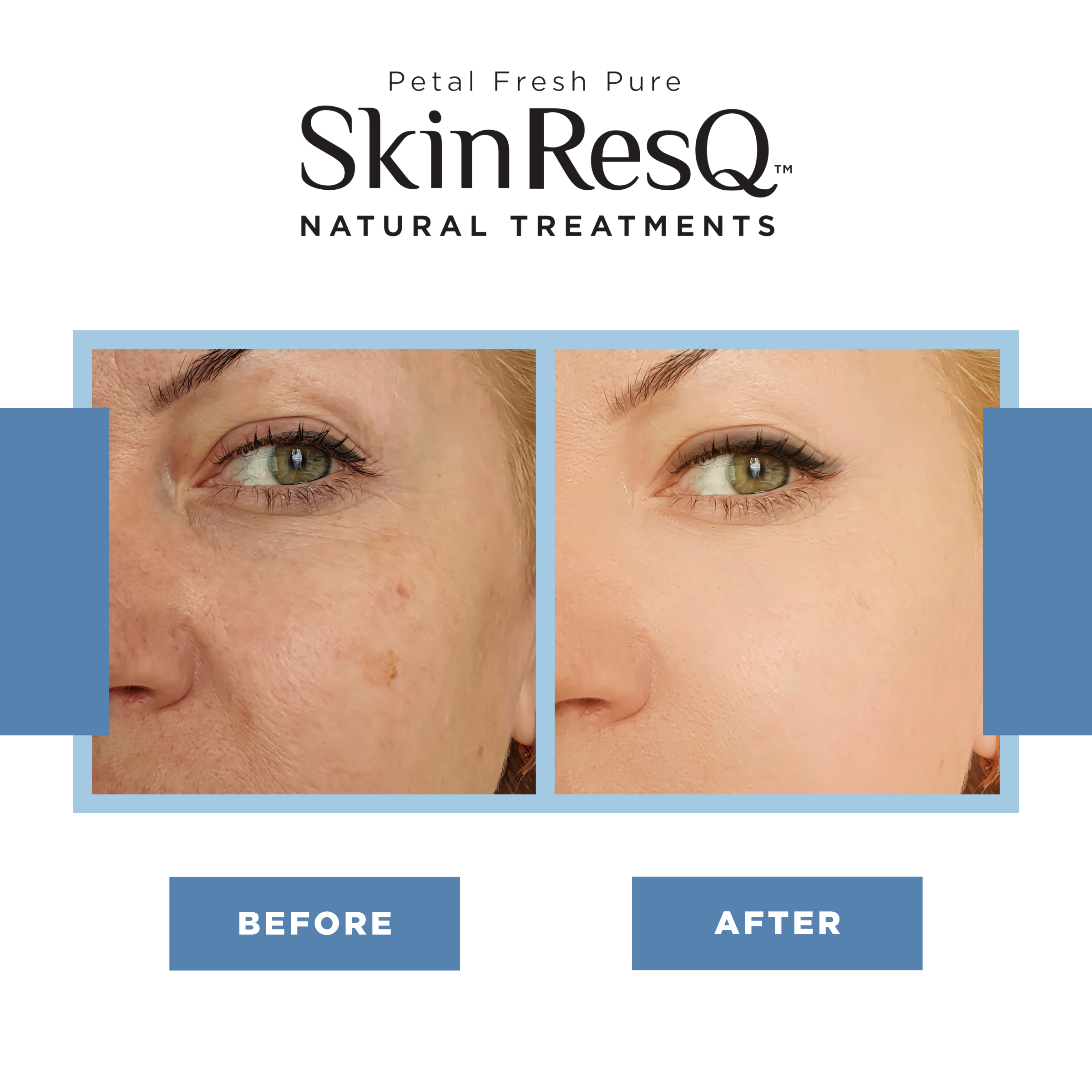 Skin ResQ Nighttime Pimple Patches